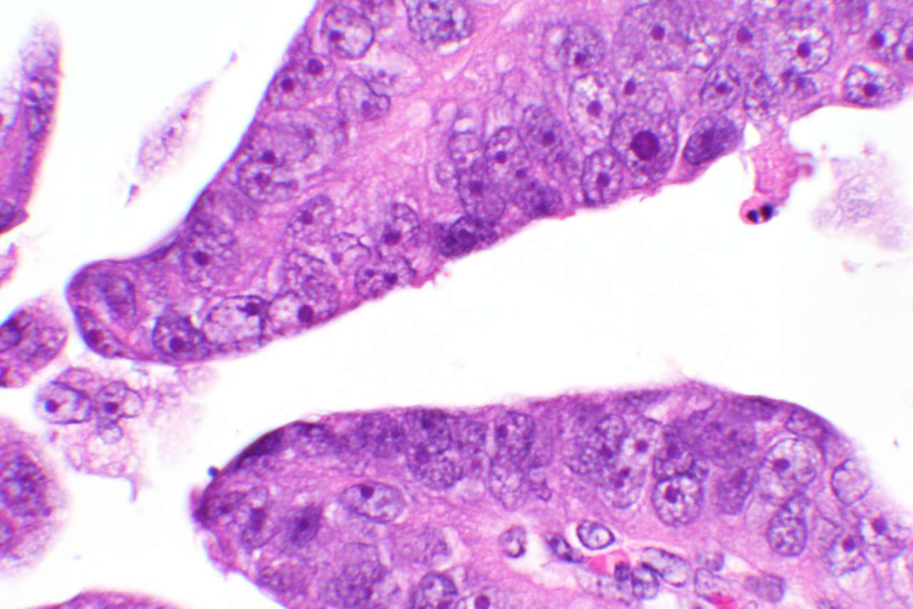 Microscopy image of uterine papillary serous carcinoma, an aggressive subtype of endometrial cancer.