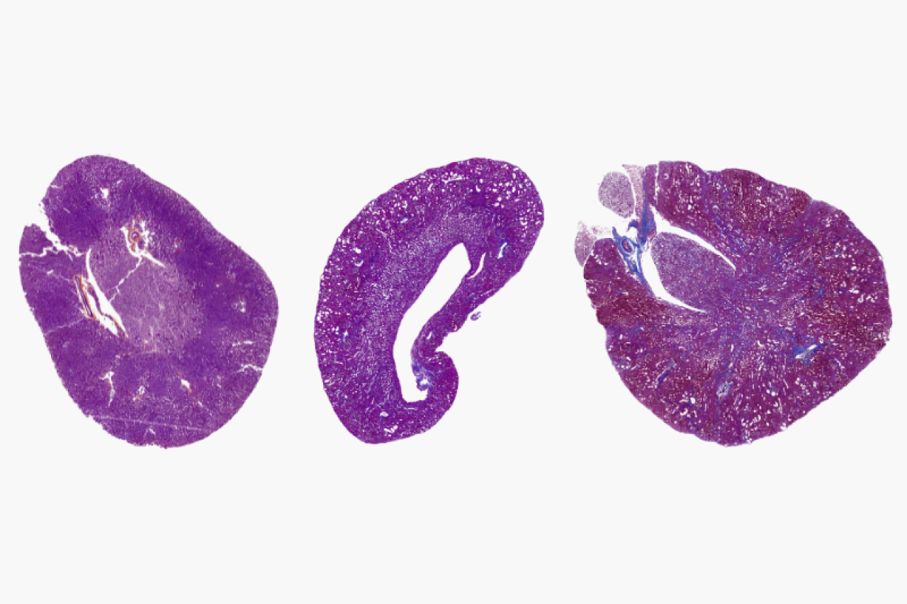 Stained kidney tissue samples showing fibrosis under different conditions