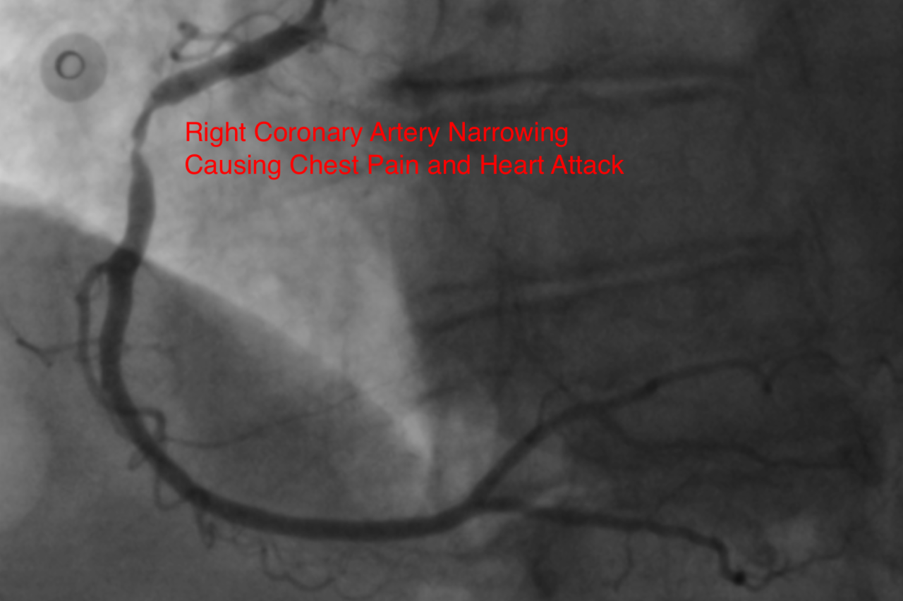 Right coronary artery narrowing causing chest pain and heart attack