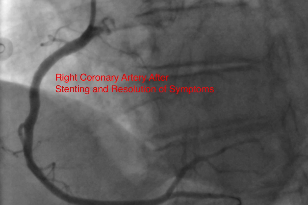 Right coronary artery after stenting and resolution of symptoms