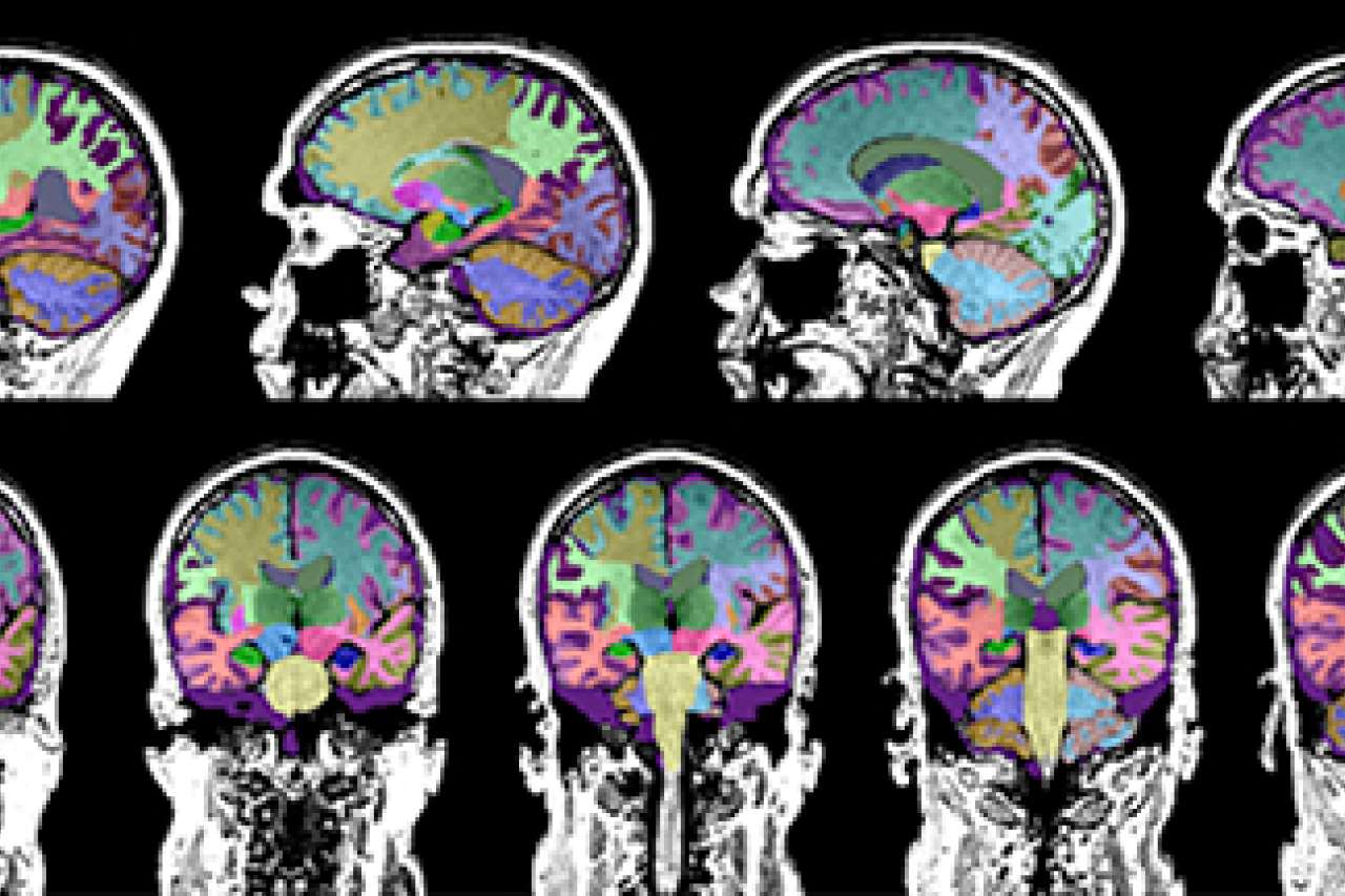MRI may help doctors differentiate causes of memory loss UCLA Health
