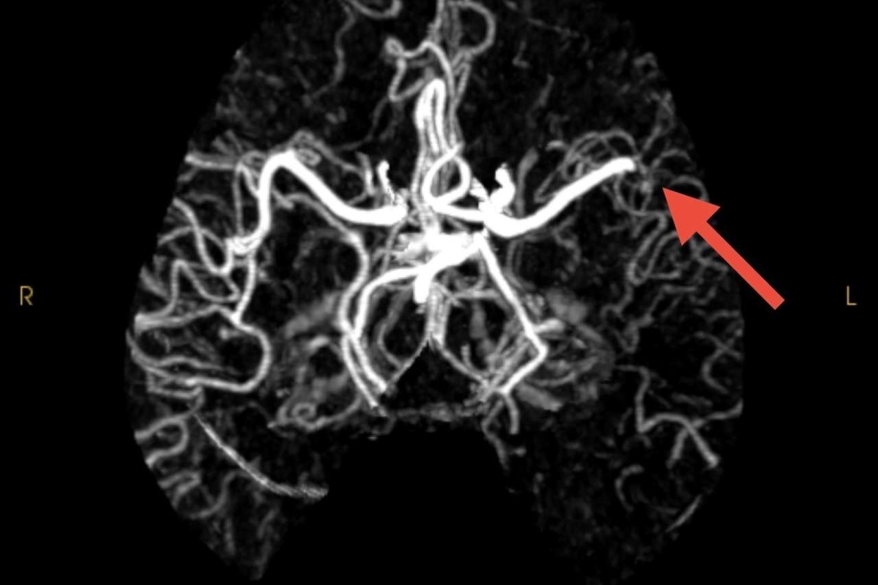 A black-and-white brain scan with a red arrow pointing to a blood vessel blockage.