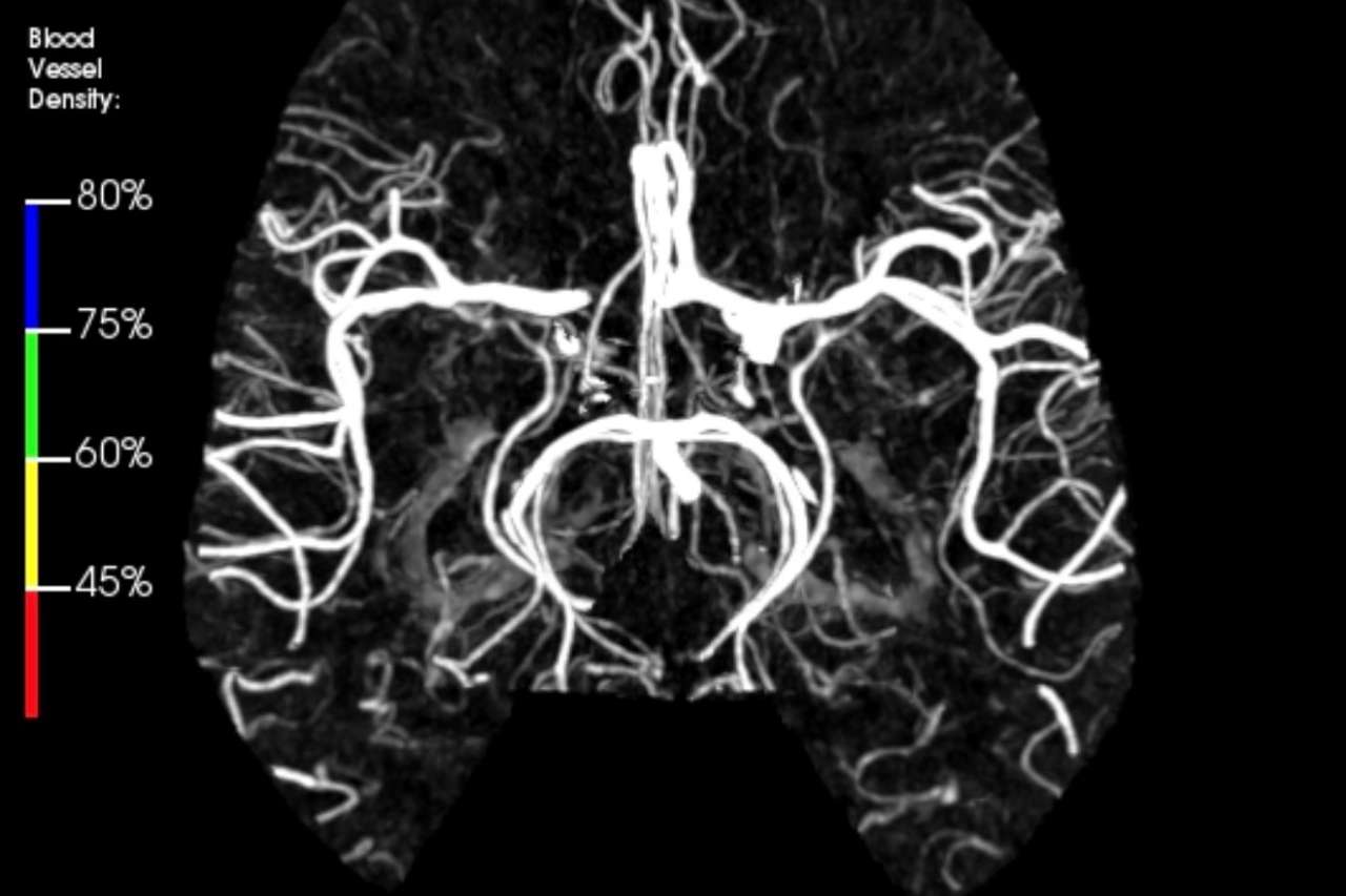A black-and-white scan of a normal brain.