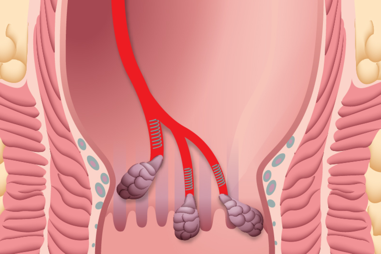 Illustration of hemorrhoids after hemorrhoidal artery embolization