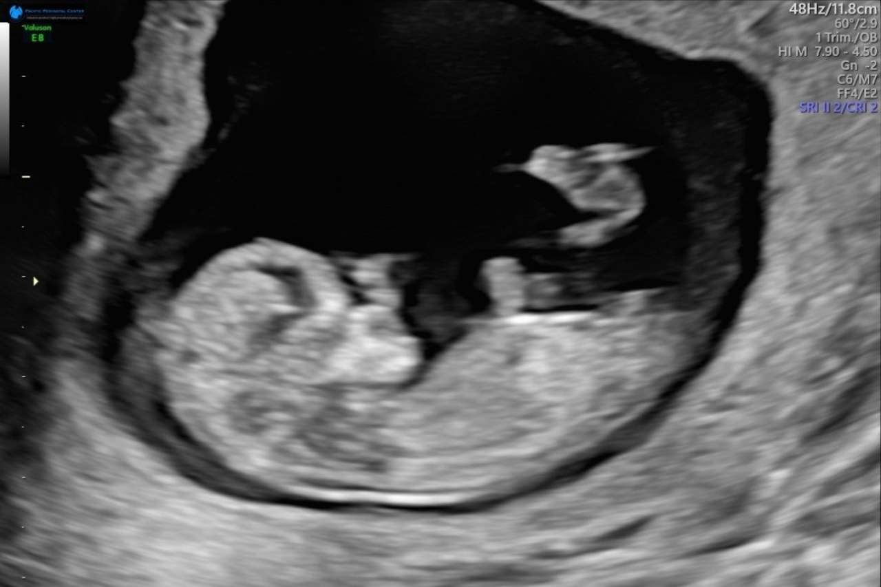 Sonogram of a fetus with the wispy image resembling a hummingbird.