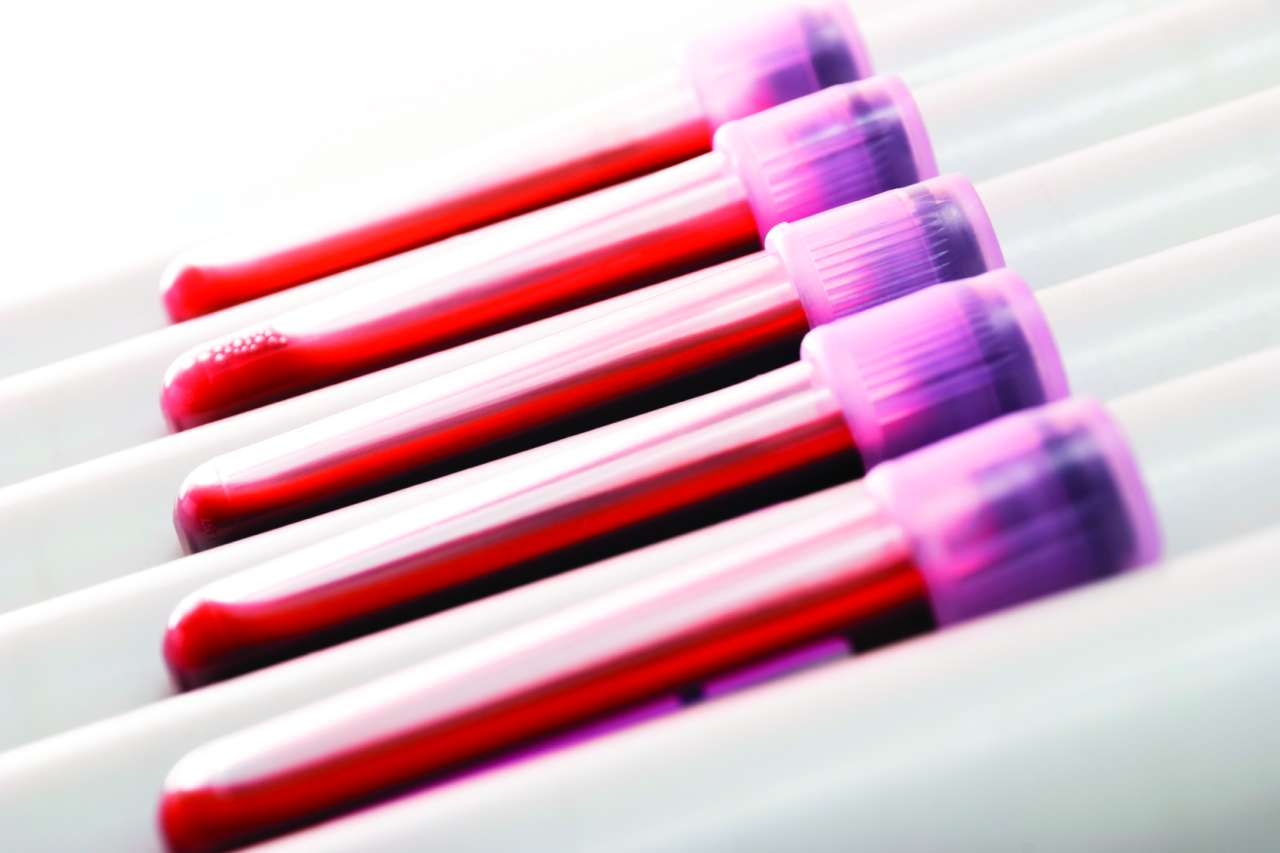 A blood test for stroke risk? Study finds network of inflammatory