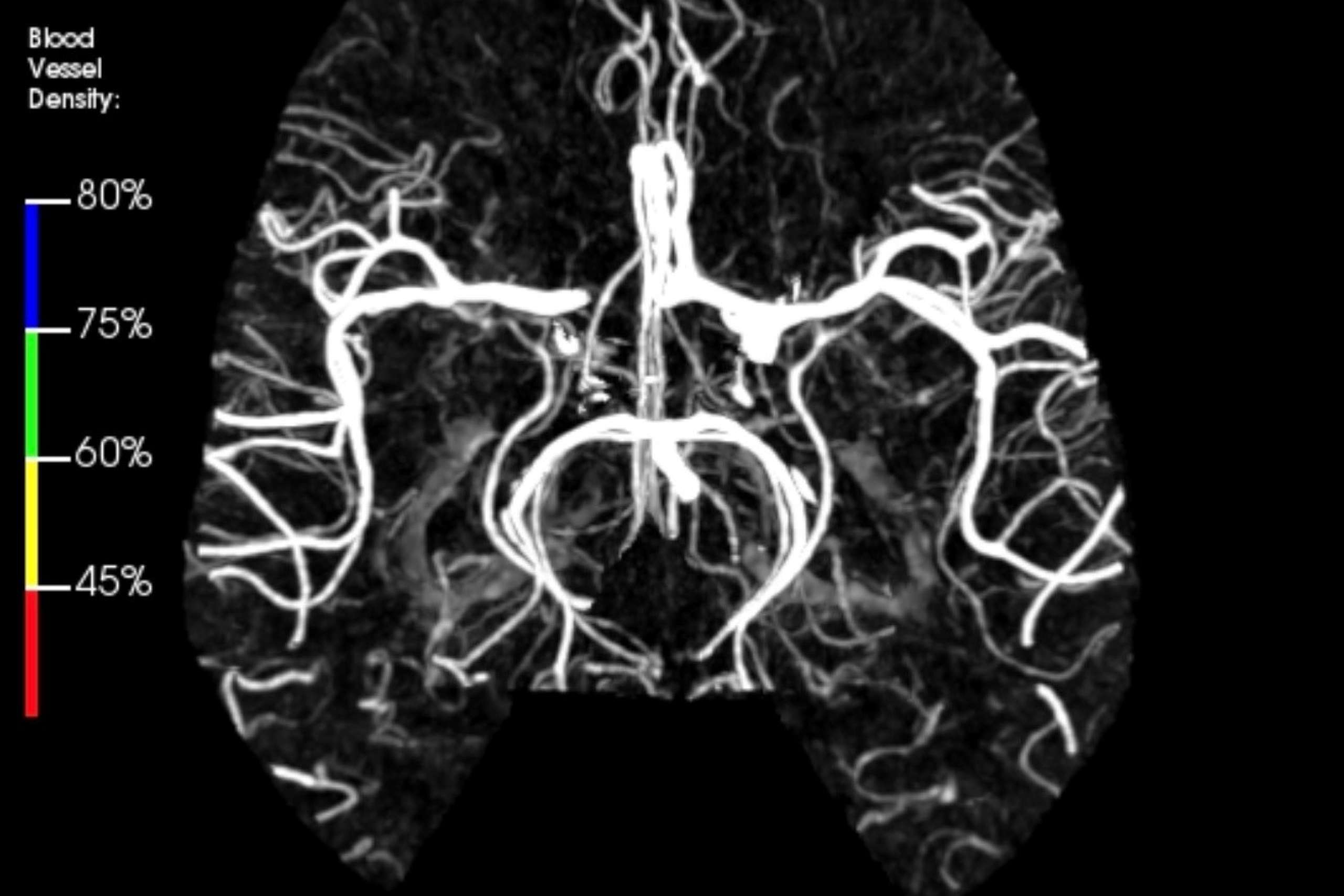 UCLA Health’s Mobile Stroke unit performs first mobile brain perfusion ...