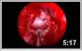  Endoscopic Removal of Pituitary Tumors Video Preview