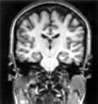 Epilepsy imaging