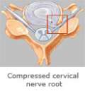 Compressed cervical nerve root