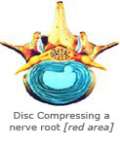 Disc compressing a nerve root