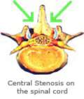 Central stenosis on the spinal cord