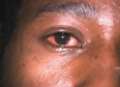 African American person with conjunctivitis