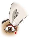 Lift upper eyelid