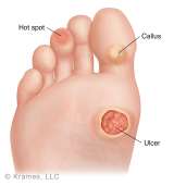 illustration of foot with ulcer. Diabetes program.