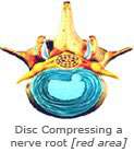 Disc Compressing a nerve root [red area]