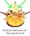 Central Stenosis on the spinal cord