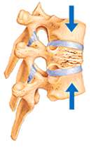 Illustration of Spinal Compression Fracture
