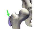 Illustration of Trochanteric Bursitis in femur