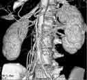 CTA Renal Aorta