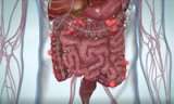 Diverticulitis Patient Education Video