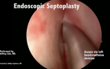 Endoscopic Septoplasty Screenshot