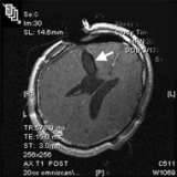 This MRI shows complete removal of the tumor