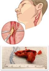 illustration of a carotid endarterectomy plaque removal surgery