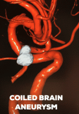 Brain Aneurysm After Coiling