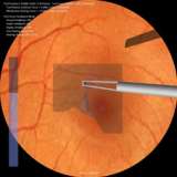 Vitroretinal surgery manipulation