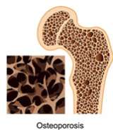 Osteoporosis
