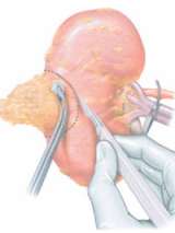 Partial Nephrectomy