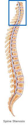 Spine Stenosis illustration