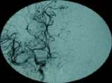 Angiograph before rTPA procedure