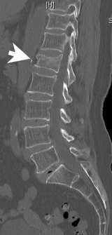 Figure 1. A typical lumbar compression fracture (white arrow)