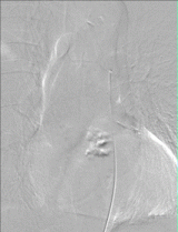 GIF of pinal angiogram