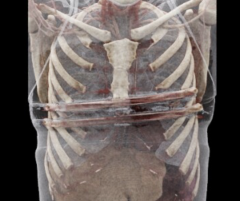 Ribs with bars across to correct sunken chest syndrome