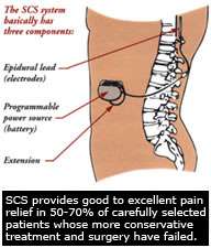 Illustration of Spinal Cord Stimulation