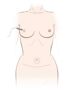 Nipple Reconstruction and Areola Tattoo