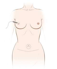 Illustration of reconstructing nipple and areola tattooing