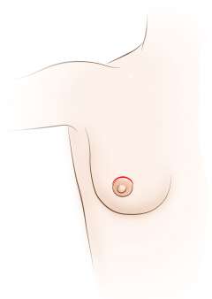 Incision Around Areola