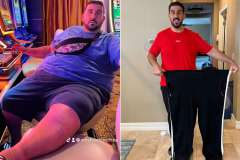 Elven's Story - Gastric Sleeve, Before and After Photos