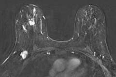 UCLA Radiology Breast Imaging Teaching Resources: Teaching Files