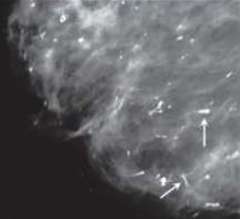 Large Rod-like Calcifications