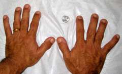 Photo of mans hands experiencing gigantism