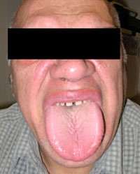 Man with enlarged tongue sticking out