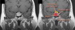 MRI of pituitary gland