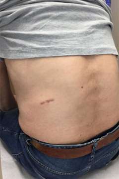Scar after single incision retroperitoneoscopic adrenalectomy