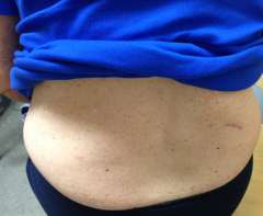 Appearance of scars 2 weeks after single-incision retroperitoneoscopic adrenalectomy.