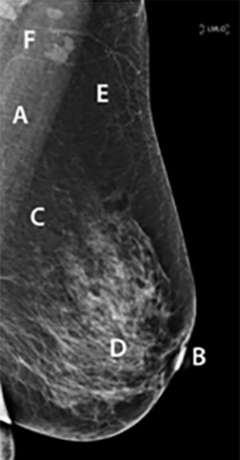 Medio-lateral mammogram of breast preferentially showing pectoralis muscle, glands, some lymph nodes, fat tissue, nipple, and blood vessels